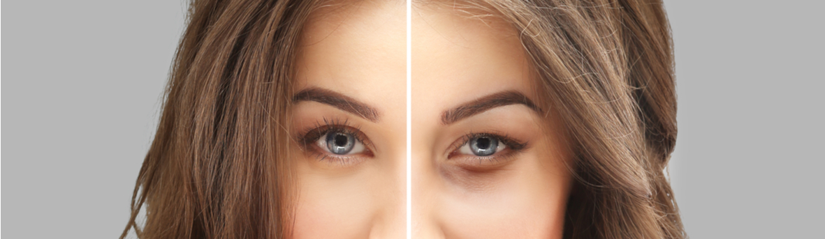 Behandeling ooglidcorrectie, technieken van een ooglidcorrectie. Herstellen van een ooglidcorrectie. Ooglidcorrectie, hoe lang herstel?