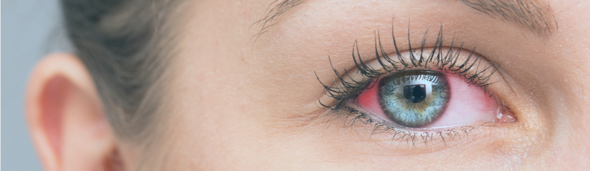 Symptomen ontstoken ogen, wat kan ik doen bij een ontstoken oog, tips ontstoken oog, oorzaken ontstoken oog.