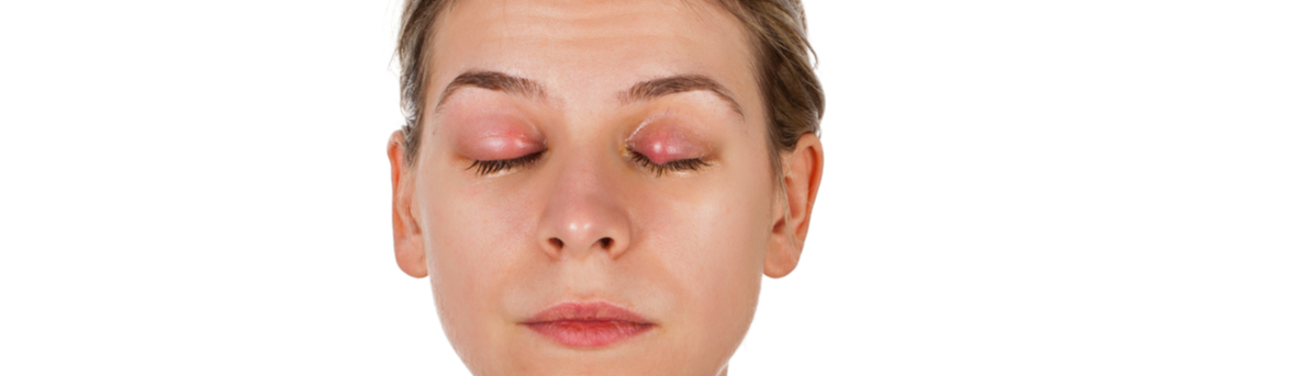 Oorzaak van een buitje op het ooglid. Wat is een chalizion.