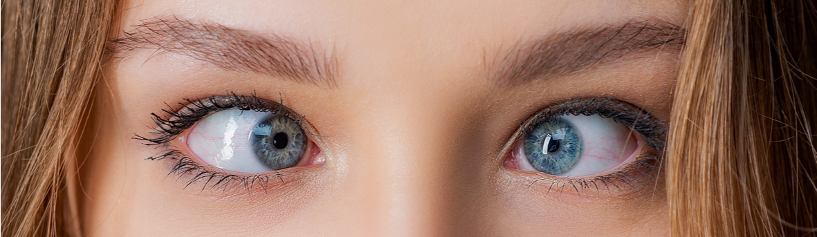 Wat zijn de oorzaken, symptomen en behandeling voor scheelzien. Scheelzien bij kind. Scheelzien corrigeren